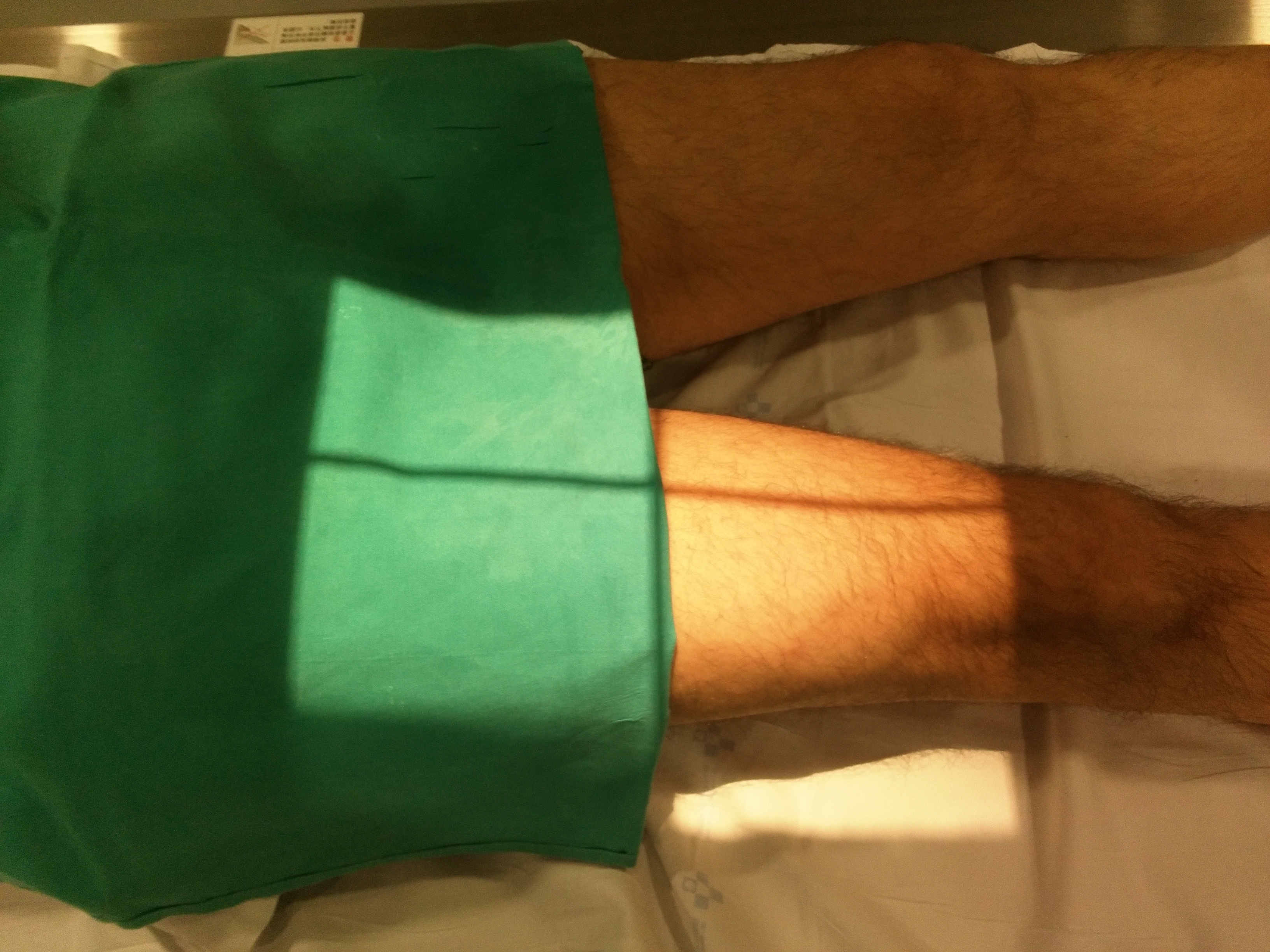 Proyección AP Fémur